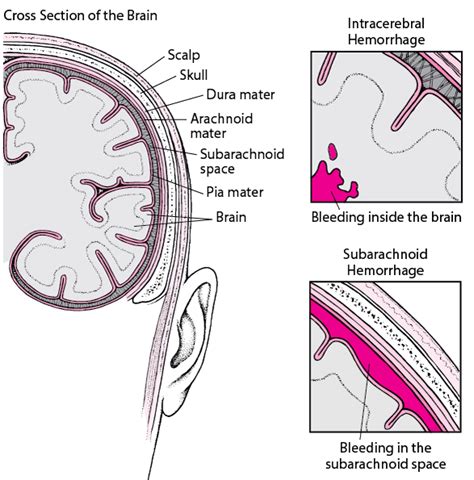 Intracerebral Hemorrhage Brain Spinal Cord And Nerve Disorders
