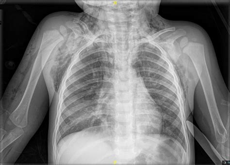 fotografía de la radiografía de tórax del niño mostrar cuello tórax