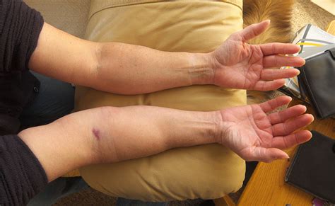 How To Treat Swollen Limbs With Lymphedema Products Ames Walker