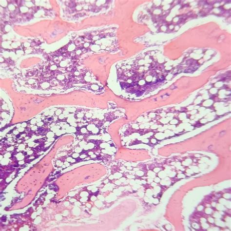 Cancellous Bone Also Called Trabecular Or Spongy Bone He Stain