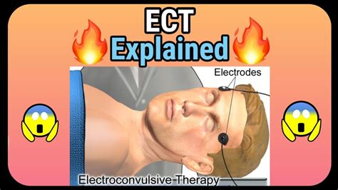 Electroconvulsive Therapy Ect Explained How It Is Performed Youtube