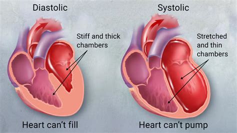 Congestive Heart Failure Explained Central Georgia Heart Center