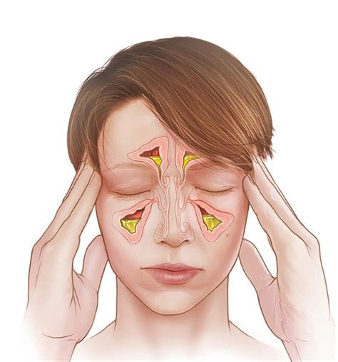 Physiotherapy In Sinusitis