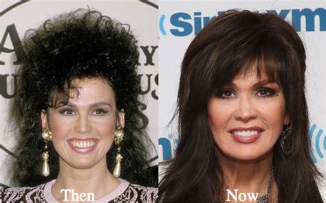 Marie Osmond Plastic Surgery Before And After Photos Latest Plastic