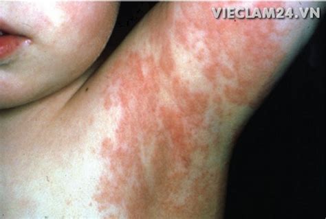 Viral Exanthems Rashes Diagnosis Symptoms Causes And Treatment Share
