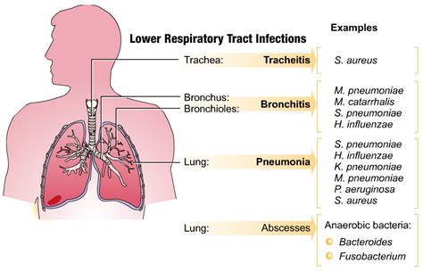 Respiratory Tract Infections Symptoms Causes And Treatment Rijal