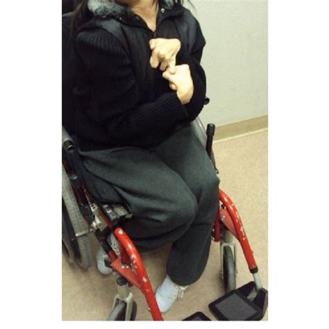 2 Quadriplegic Cerebral Palsy A 26 Year Old Female With Quadriplegic