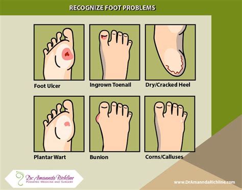How Do Your Feet Look Can You Recognize These Common Foot Problems