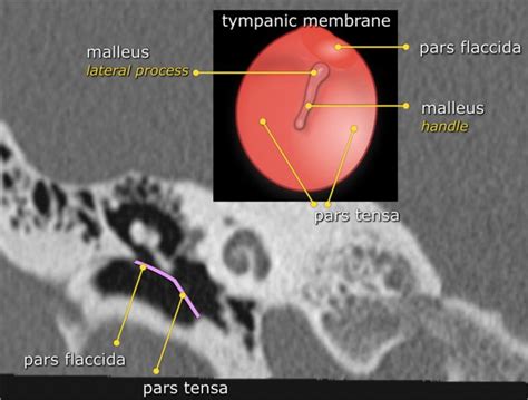 Normal Tympanic Membrane Labeled