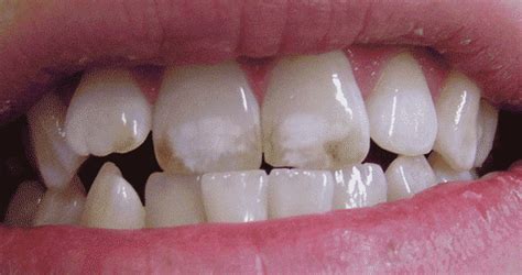 Knowledge And Public Perception Of Dental Fluorosis In Children Living