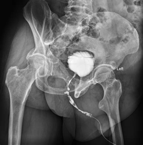Multifocal Urethral Strictures In A Patient With Hypospadias Image