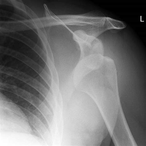 Shoulder Dislocation X Ray