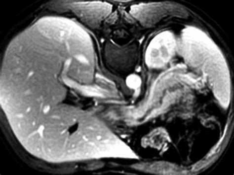 Abdominal Mri Showing An Enlarged Pancreas With Enhancement Of The