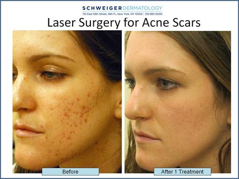How To Treat Deep Pitted Acne Scars Fractional Co2 Laser For Scars
