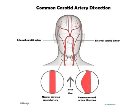 Carotid Arteries Diagram Vertebral And Internal Carotid Arteries