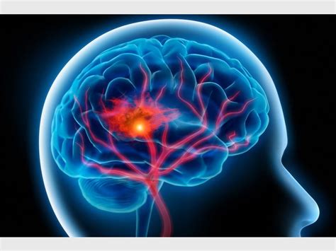 How To Spot The Onset Of A Stroke Kempton Express