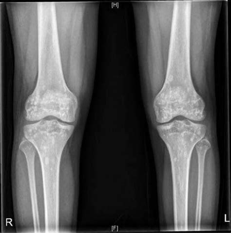 Spotted Bone Disease Bmj Case Reports