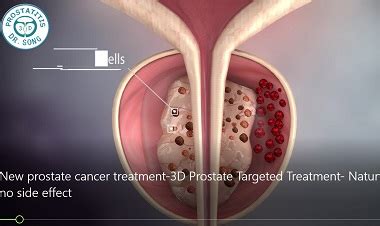 The prostate is the largest accessory gland in the male reproductive system. Advanced 3D Prostate Targeted Therapy Successfully Treats ...