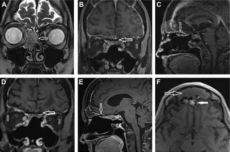 Neurosurgical Approaches To The Skull Base Neuroimaging Clinics