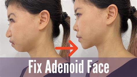What Is Adenoid Face How To Improve Koko Face Yoga