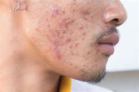 Stryx What Is Fungal Acne Causes Treatments And Symptoms