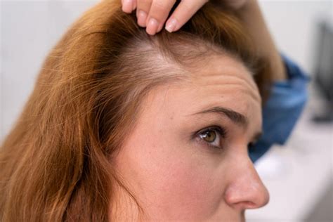 First Signs Of Hair Thinning In Women