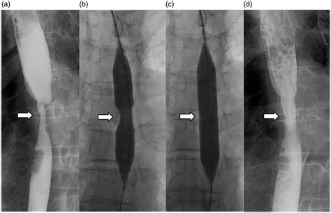 Radiation Induced Esophageal Strictures Treated With Fluoroscopic