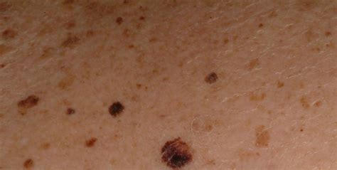 Skin Cancer Apps Can Be Dangerously Wrong Huffpost Life