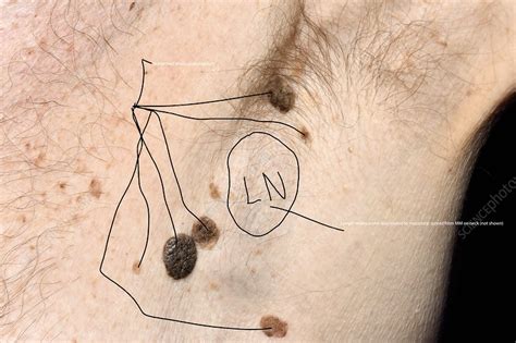 Swollen Lymph Node In Metastatic Melanoma Stock Image C0506871