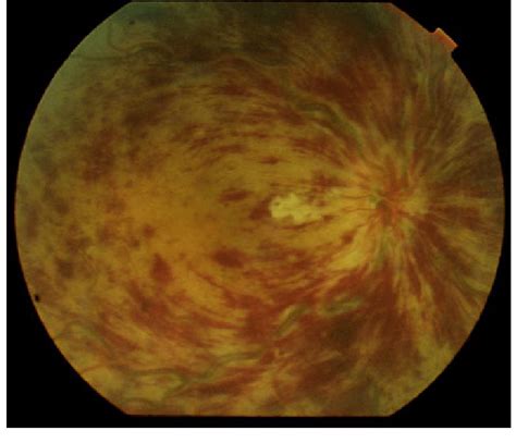 Central Retinal Vein Occlusion Crvo With Venous Dilatation And