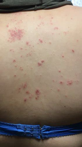 赤いブツブツかゆい 赤いブツブツが体中に ここ2週間できて ...