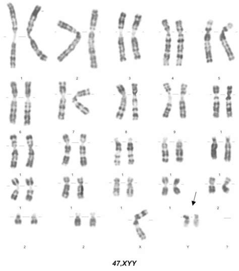 Amniocentesis Results Showing 47 Xyy Karyotype Download Scientific Diagram