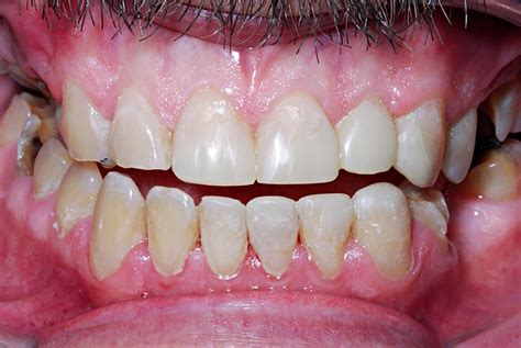 Plus, dental bonding is sometimes covered by insurance. Cosmetic Bonding & Teeth Whitening | Zimmerman Dental Care