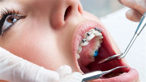 Braces And Orthodontic Treatment Solar Dental And Orthodontics