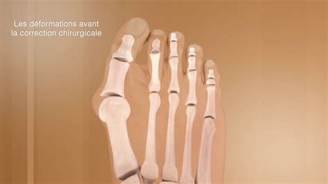 La Correction De L Hallux Valgus Et De Ses Complications Chirurgie Du Pied Clinique Du Parc