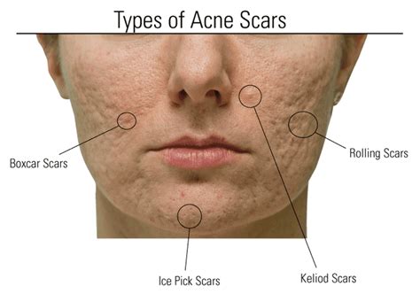 Types Of Acne Scars Types Of Acne Scars And How To Treat Them