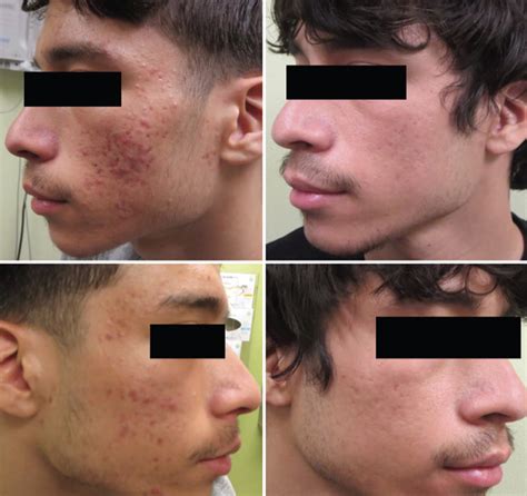 laser therapy for atrophic acne scars a case and evidence based updates practical dermatology