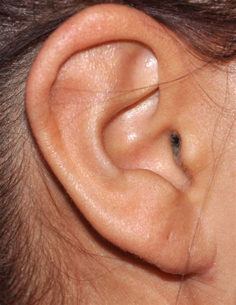Earlobe Reduction Of The Age Related Long Ear Explore Plastic Surgery