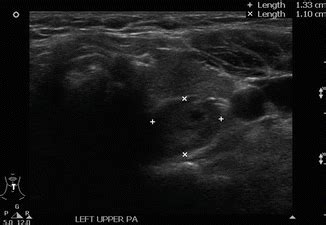 Ultrasonography Of The Parathyroid Glands Radiology Key