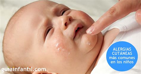 Alergia A Gesso Sintomas