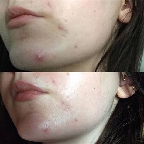 20 Things That Really And Truly Work On Cystic Acne Pustules Acne