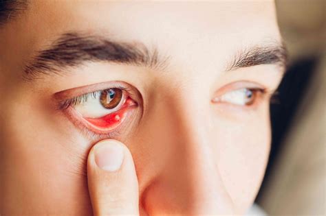 How To Treat A Stye Inside The Eyelid 2022