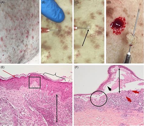 A‐f Lichenoid Drug Eruption Blister Bulla Formation As A Positive