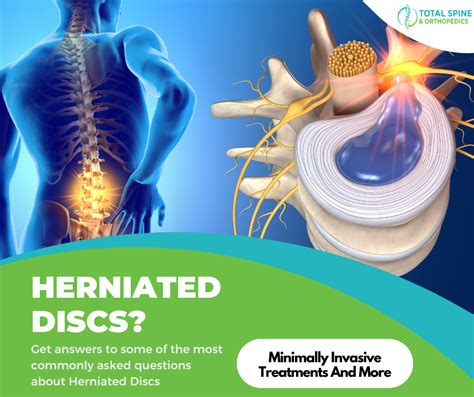 Understanding Herniated Discs Symptoms And Treatments