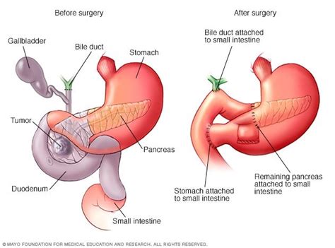 Pancreatic cancer is relatively rare but notoriously lethal. Pancreatic Cancer Treatment Market 2019 Analysis and ...