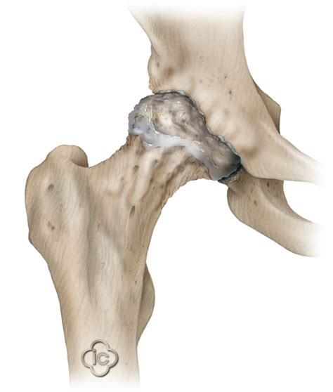 Total Hip Replacement Surgery Hip Prosthesis 2022