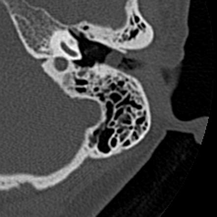 External Auditory Canal Cholesteatoma Radiology Reference Article