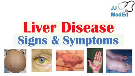 Liver Disease Signs And Symptoms Ex Gynecomastia Bruising Hepatic