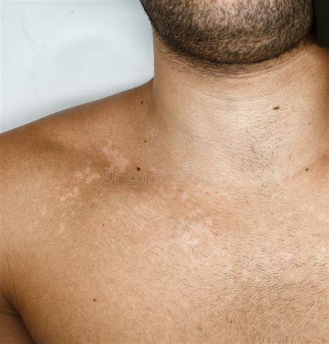 Image Of White Spots On The Skin Of A Manand X27s Chest Due To Fungus