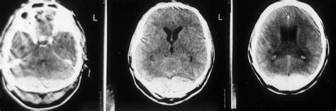 Bilateral Epidural Hematoma Extending From The Posterior Fossa To The